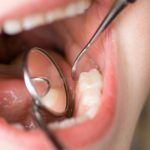 10 mitos e verdades sobre CÁRIES