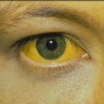 Olhos amarelados? Saiba o que pode ser