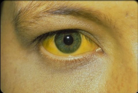 Olhos amarelados? Saiba o que pode ser