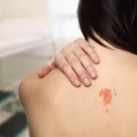 DEZEMBRO LARANJA: Manchas podem ser sinal de câncer de pele