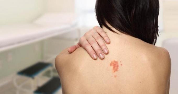 DEZEMBRO LARANJA: Manchas podem ser sinal de câncer de pele