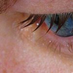 O que fazer quando os olhos lacrimejam sem parar?