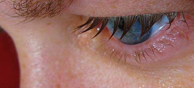 O que fazer quando os olhos lacrimejam sem parar?