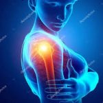 Já ouviu falar em ombro congelado?