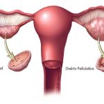 A Síndrome dos Ovários Policísticos