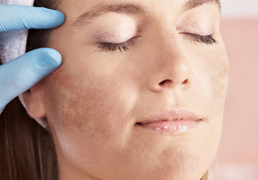 Melasma: como cuidar? Veja cinco passos que te auxiliarão no tratamento dessas manchas