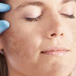 Melasma: como cuidar? Veja cinco passos que te auxiliarão no tratamento dessas manchas