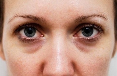 Como acabar com as olheiras?