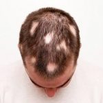 Alopecia Aerata? Patologia afeta participante do BBB