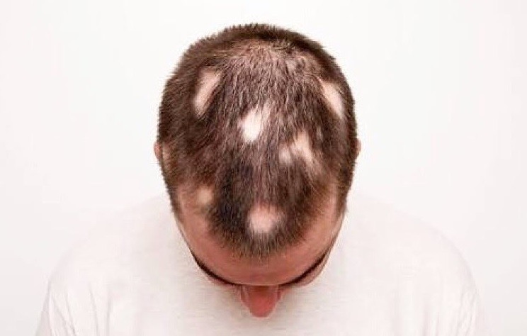 Alopecia Aerata? Patologia afeta participante do BBB