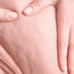 Celulite: é possível tratar ou prevenir?