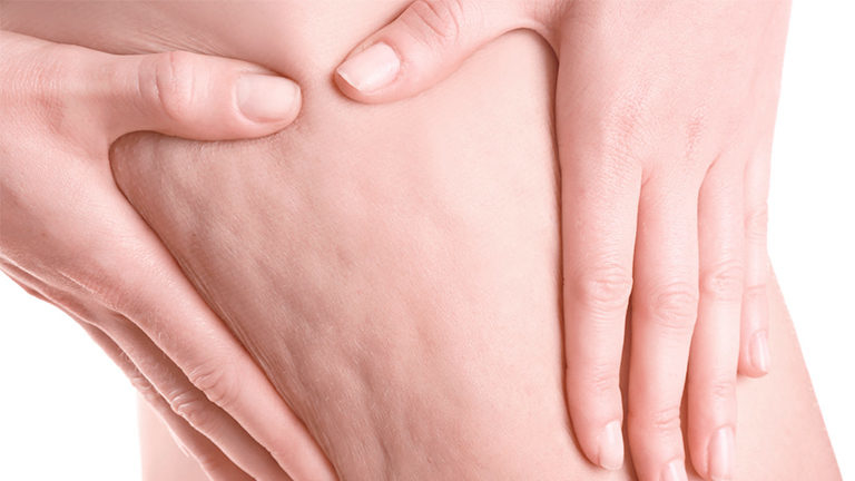 Celulite: é possível tratar ou prevenir?