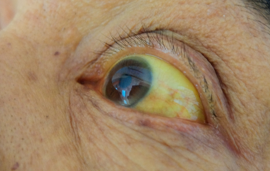 Olhos amarelados: o que pode ser?