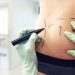 Abdominoplastia X Lipoaspiração. Qual a Diferença?