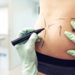 Abdominoplastia X Lipoaspiração. Qual a Diferença?